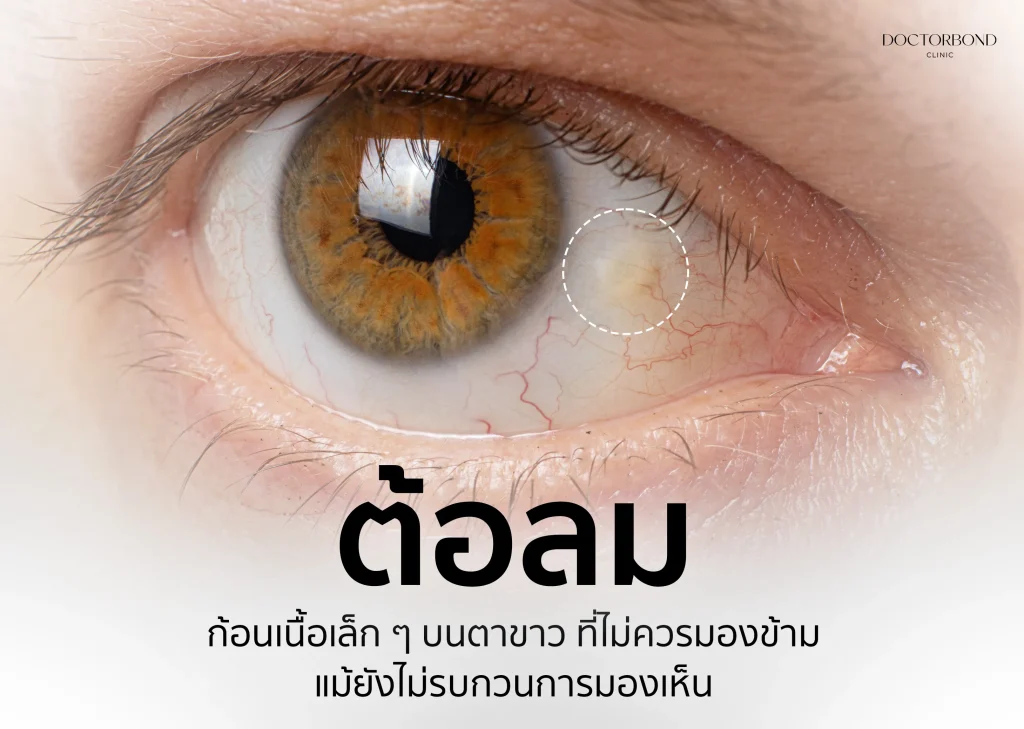 ต้อลม