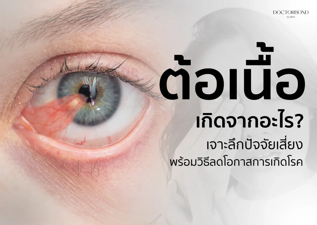 ต้อเนื้อ