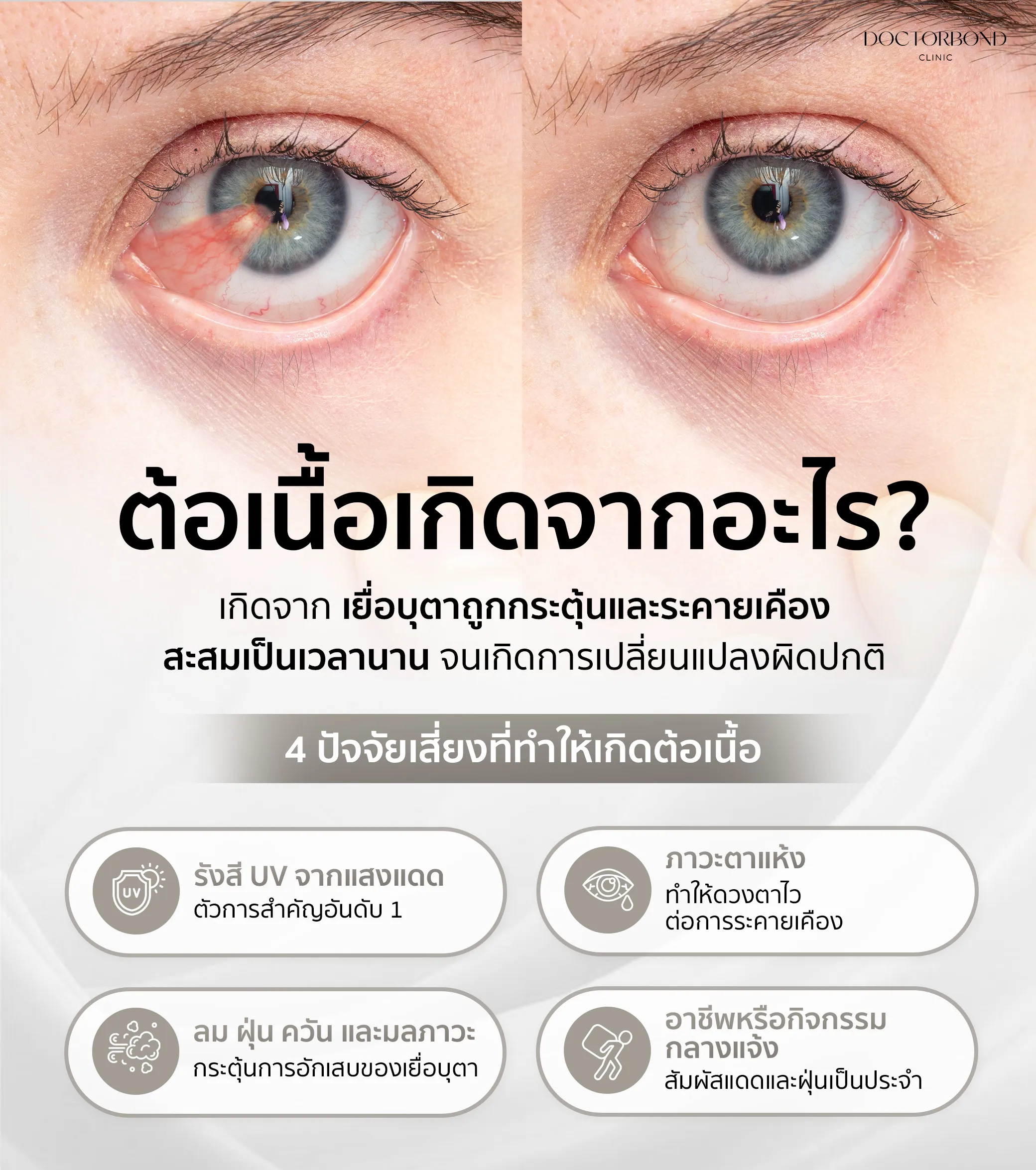 ต้อเนื้อ